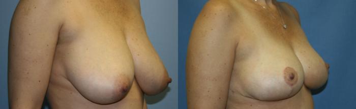 Breast Reduction Case 32 Before & After View #2 | Downers Grove, IL | Dr. Sandeep Jejurikar