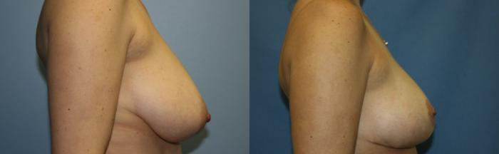 Breast Reduction Case 32 Before & After View #3 | Downers Grove, IL | Dr. Sandeep Jejurikar