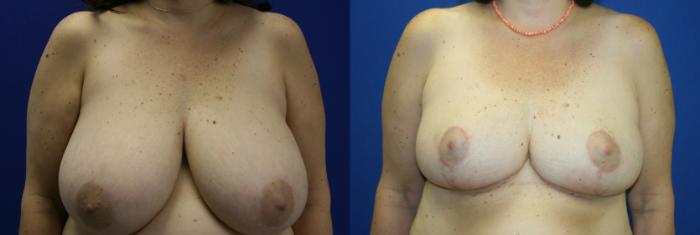 Breast Reduction Case 44 Before & After View #1 | Downers Grove, IL | Dr. Sandeep Jejurikar