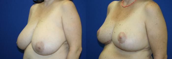 Breast Reduction Case 44 Before & After View #3 | Downers Grove, IL | Dr. Sandeep Jejurikar