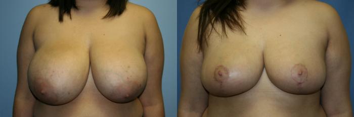 Breast Reduction Case 49 Before & After View #1 | Downers Grove, IL | Dr. Sandeep Jejurikar