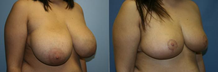 Breast Reduction Case 49 Before & After View #2 | Downers Grove, IL | Dr. Sandeep Jejurikar