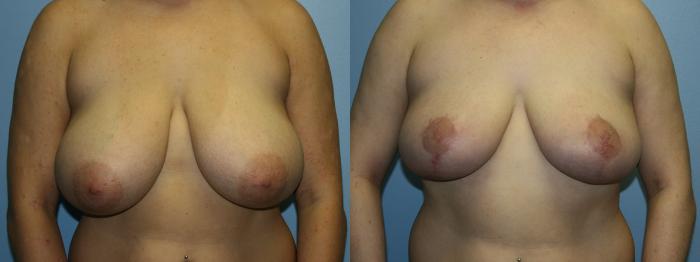 Breast Reduction Case 51 Before & After Front | Downers Grove, IL | Dr. Sandeep Jejurikar