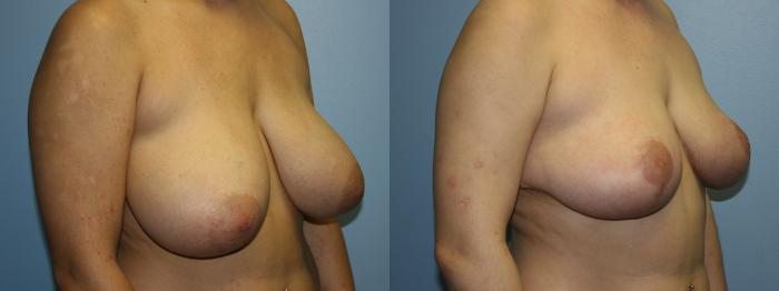 Breast Reduction Case 51 Before & After Right Oblique | Downers Grove, IL | Dr. Sandeep Jejurikar