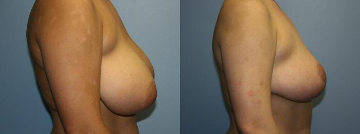 Breast Reduction Case 51 Before & After Right Side | Downers Grove, IL | Dr. Sandeep Jejurikar