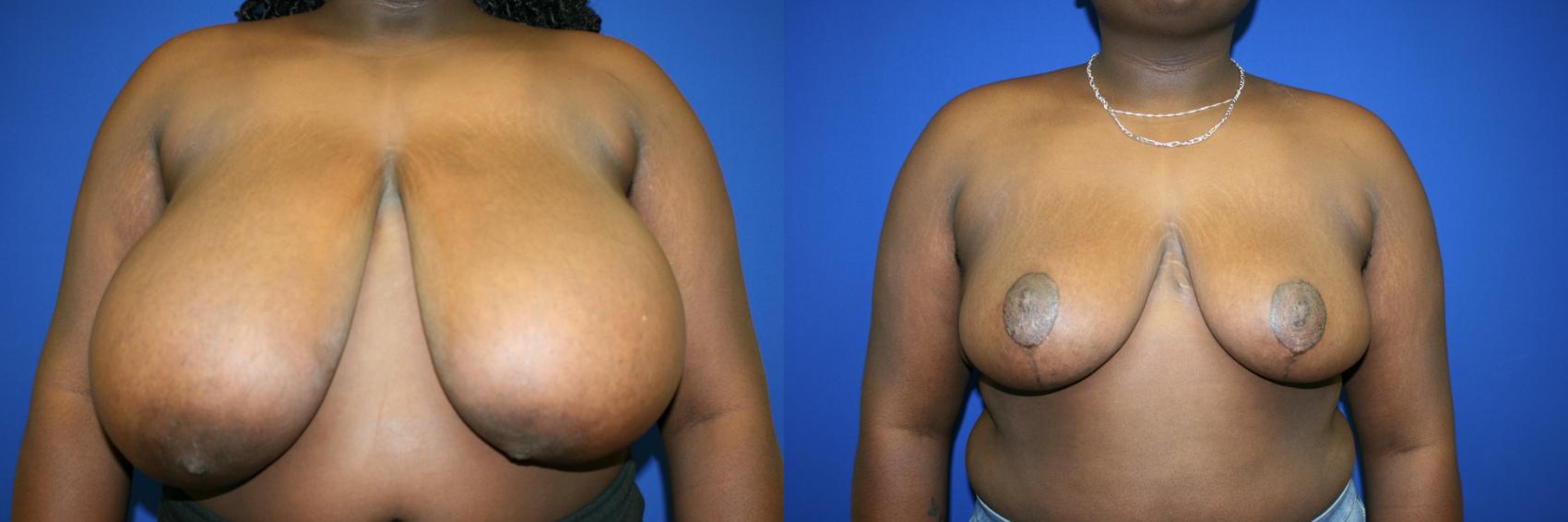 Breast Reduction Case 54 Before & After Front | Downers Grove, IL | Dr. Sandeep Jejurikar