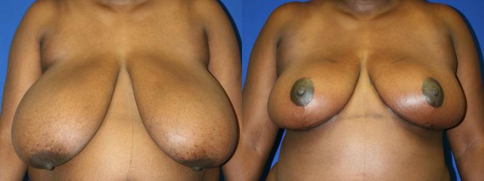 Breast Reduction Case 70 Before & After Front | Downers Grove, IL | Dr. Sandeep Jejurikar