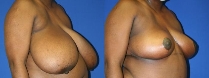 Breast Reduction Case 70 Before & After Right Oblique | Downers Grove, IL | Dr. Sandeep Jejurikar