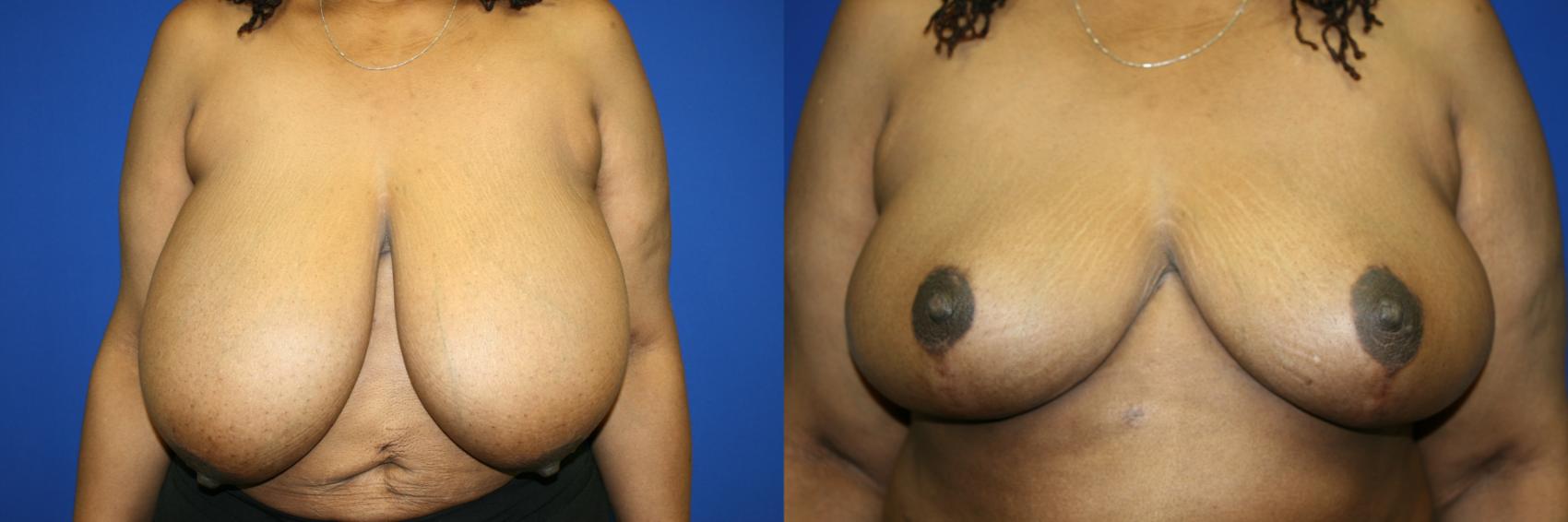 Breast Reduction Case 82 Before & After Front | Downers Grove, IL | Dr. Sandeep Jejurikar