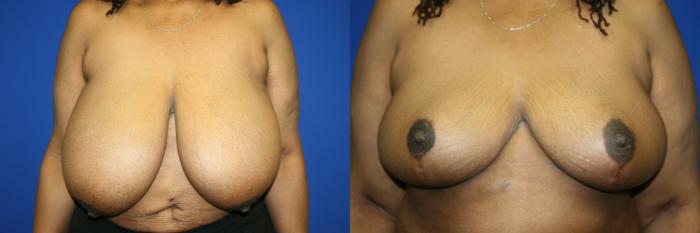 Breast Reduction Case 82 Before & After Front | Downers Grove, IL | Dr. Sandeep Jejurikar