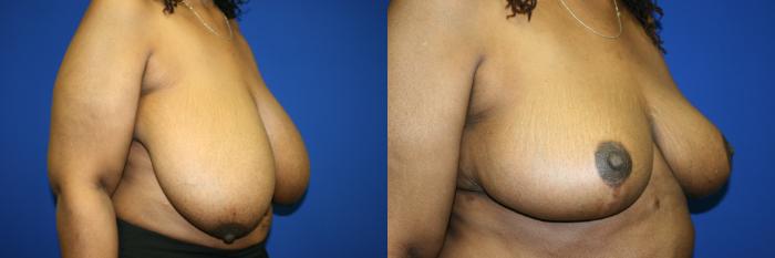 Breast Reduction Case 82 Before & After Right Oblique | Downers Grove, IL | Dr. Sandeep Jejurikar