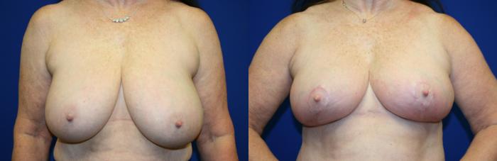Breast Reduction Case 90 Before & After Front | Downers Grove, IL | Dr. Sandeep Jejurikar