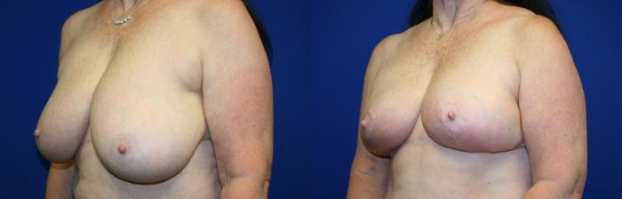 Breast Reduction Case 90 Before & After Left Oblique | Downers Grove, IL | Dr. Sandeep Jejurikar