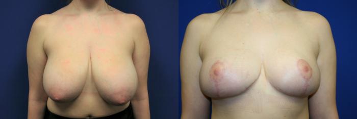 Breast Reduction Case 99 Before & After Front | Downers Grove, IL | Dr. Sandeep Jejurikar
