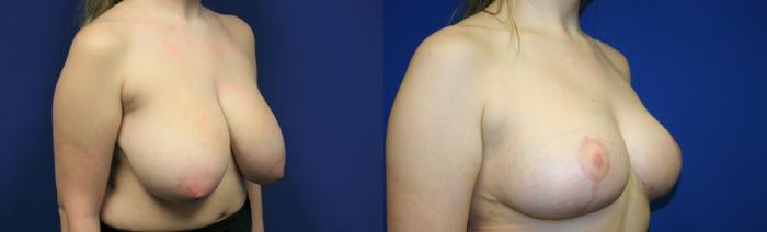 Breast Reduction Case 99 Before & After Right Oblique | Downers Grove, IL | Dr. Sandeep Jejurikar