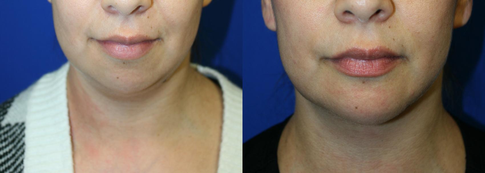 Chin Implant  Case 98 Before & After Front | Downers Grove, IL | Dr. Sandeep Jejurikar