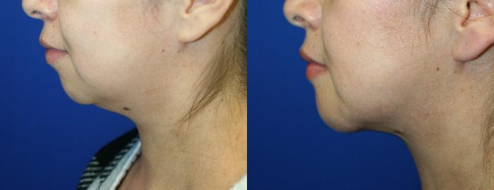 Chin Implant  Case 98 Before & After Left Side | Downers Grove, IL | Dr. Sandeep Jejurikar