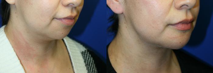 Chin Implant  Case 98 Before & After Right Oblique | Downers Grove, IL | Dr. Sandeep Jejurikar
