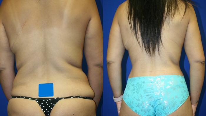 Breast Lift Case 83 Before & After Back | Downers Grove, IL | Dr. Sandeep Jejurikar