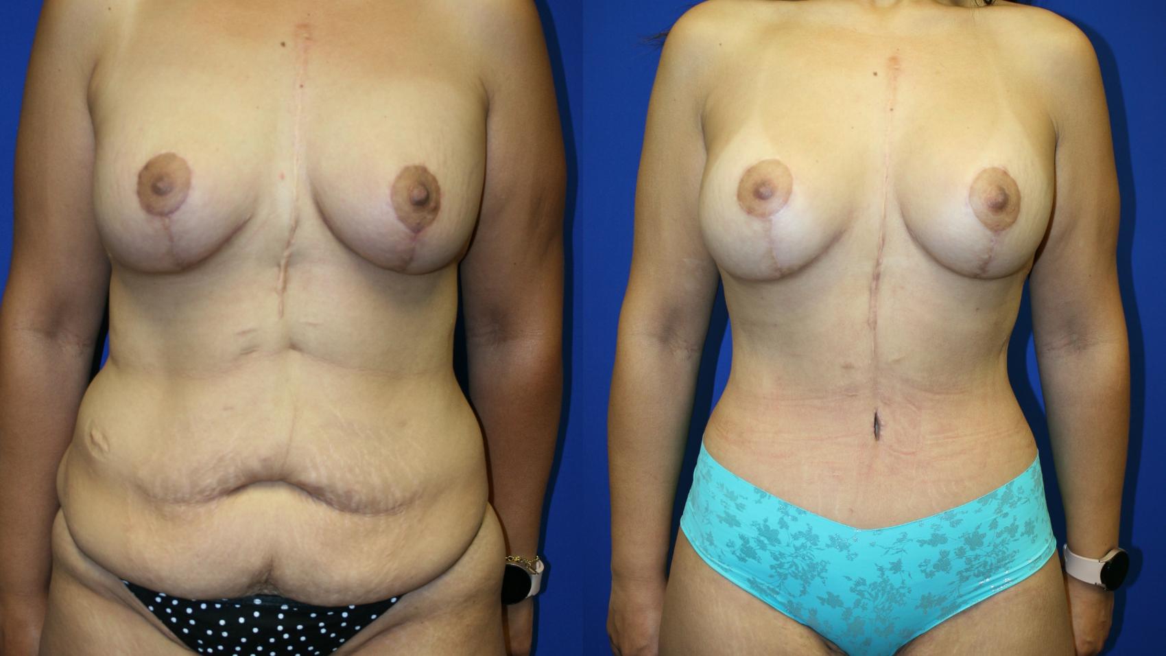 Circumferential Body Lift Case 83 Before & After Front | Downers Grove, IL | Dr. Sandeep Jejurikar