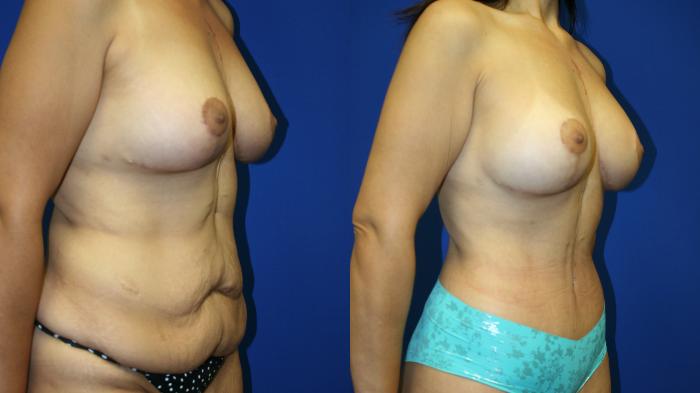 Circumferential Body Lift Case 83 Before & After Right Oblique | Downers Grove, IL | Dr. Sandeep Jejurikar