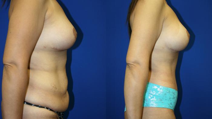 Circumferential Body Lift Case 83 Before & After Right Side | Downers Grove, IL | Dr. Sandeep Jejurikar