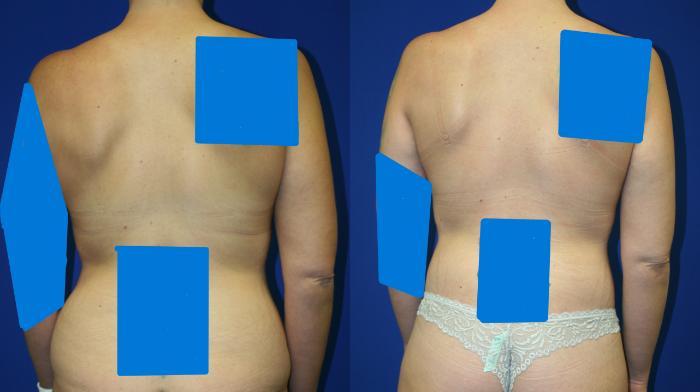 Circumferential Body Lift Case 85 Before & After Back | Downers Grove, IL | Dr. Sandeep Jejurikar