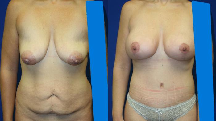 Breast Augmentation Case 85 Before & After Front | Downers Grove, IL | Dr. Sandeep Jejurikar