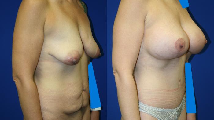 Breast Augmentation Case 85 Before & After Right Oblique | Downers Grove, IL | Dr. Sandeep Jejurikar