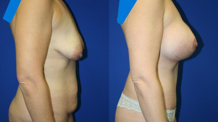 Breast Augmentation Case 85 Before & After Right Side | Downers Grove, IL | Dr. Sandeep Jejurikar