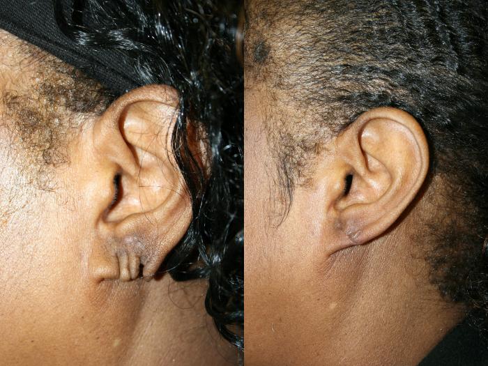 Earlobe Repair Case 84 Before & After Left Side | Downers Grove, IL | Dr. Sandeep Jejurikar