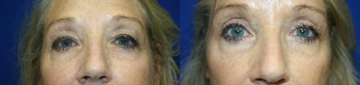 Eyelid Surgery Case 124 Before & After Front | Downers Grove, IL | Dr. Sandeep Jejurikar