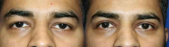Eyelid Surgery Case 137 Before & After Front | Downers Grove, IL | Dr. Sandeep Jejurikar