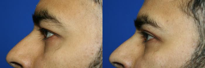 Eyelid Surgery Case 137 Before & After Left Side | Downers Grove, IL | Dr. Sandeep Jejurikar