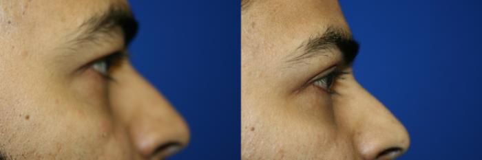 Eyelid Surgery Case 137 Before & After Right Side | Downers Grove, IL | Dr. Sandeep Jejurikar