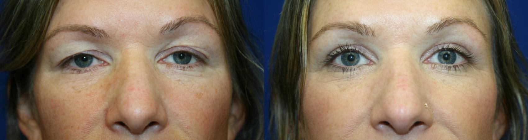 Eyelid Surgery Case 60 Before & After Front | Downers Grove, IL | Dr. Sandeep Jejurikar