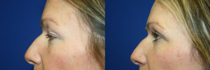 Eyelid Surgery Case 60 Before & After Left Side | Downers Grove, IL | Dr. Sandeep Jejurikar