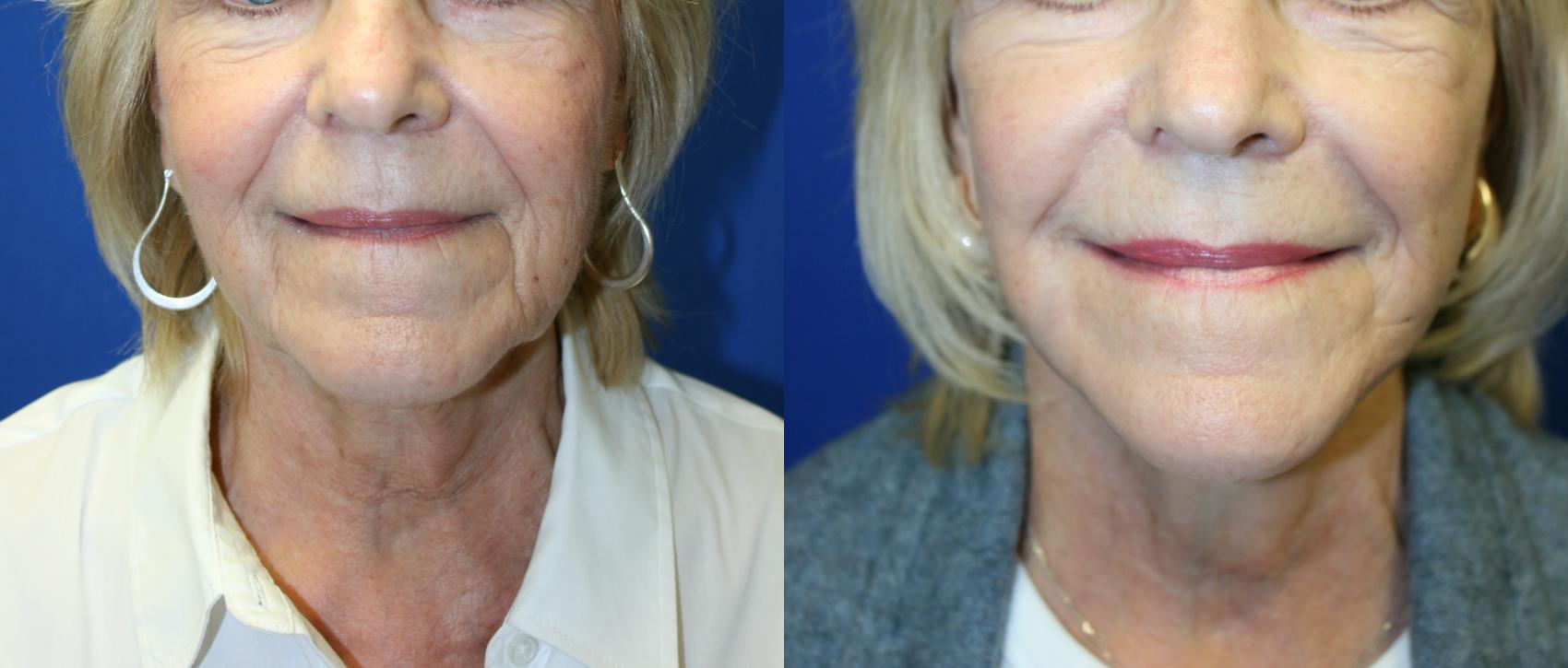 Facelift Case 132 Before & After Front | Downers Grove, IL | Dr. Sandeep Jejurikar