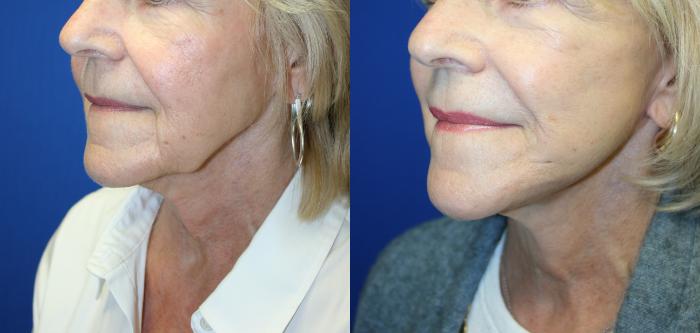 Facelift Case 132 Before & After Left Oblique | Downers Grove, IL | Dr. Sandeep Jejurikar