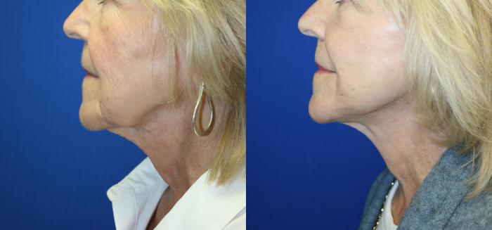 Facelift Case 132 Before & After Left Side | Downers Grove, IL | Dr. Sandeep Jejurikar