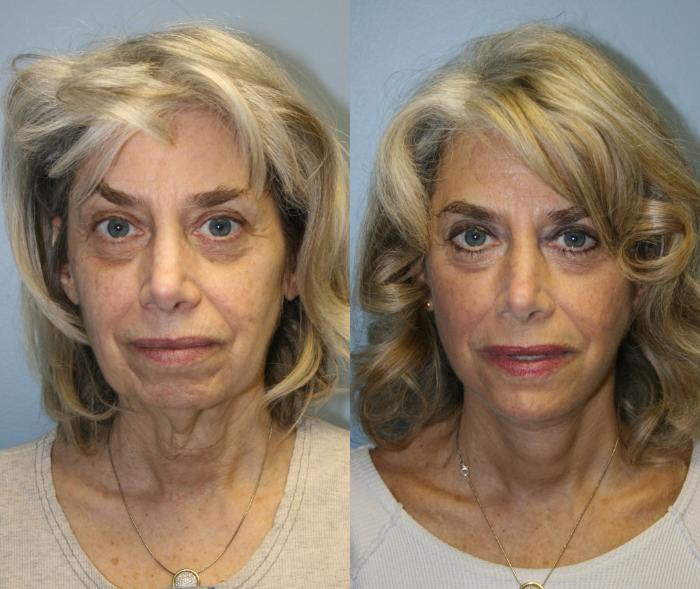 Facelift Case 19 Before & After View #1 | Downers Grove, IL | Dr. Sandeep Jejurikar