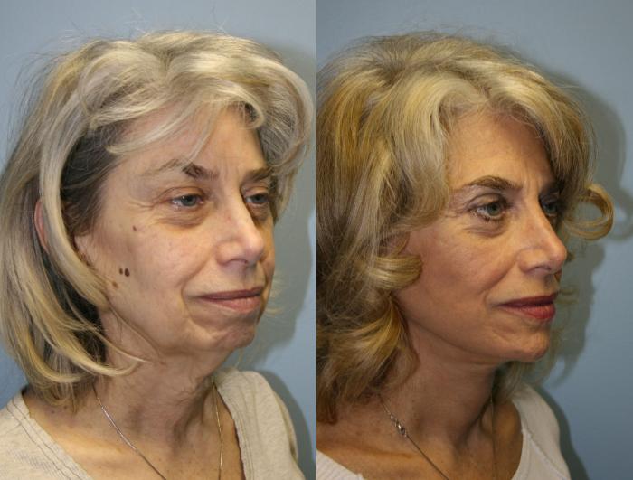 Facelift Case 19 Before & After View #2 | Downers Grove, IL | Dr. Sandeep Jejurikar