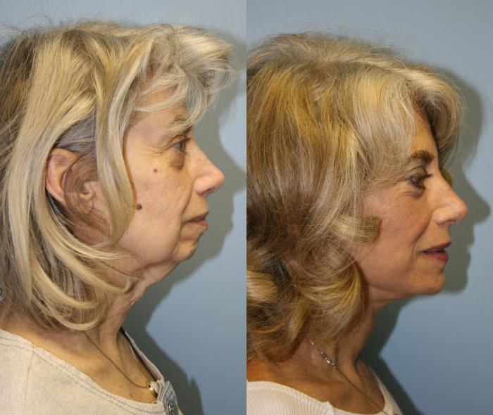 Facelift Case 19 Before & After View #3 | Downers Grove, IL | Dr. Sandeep Jejurikar