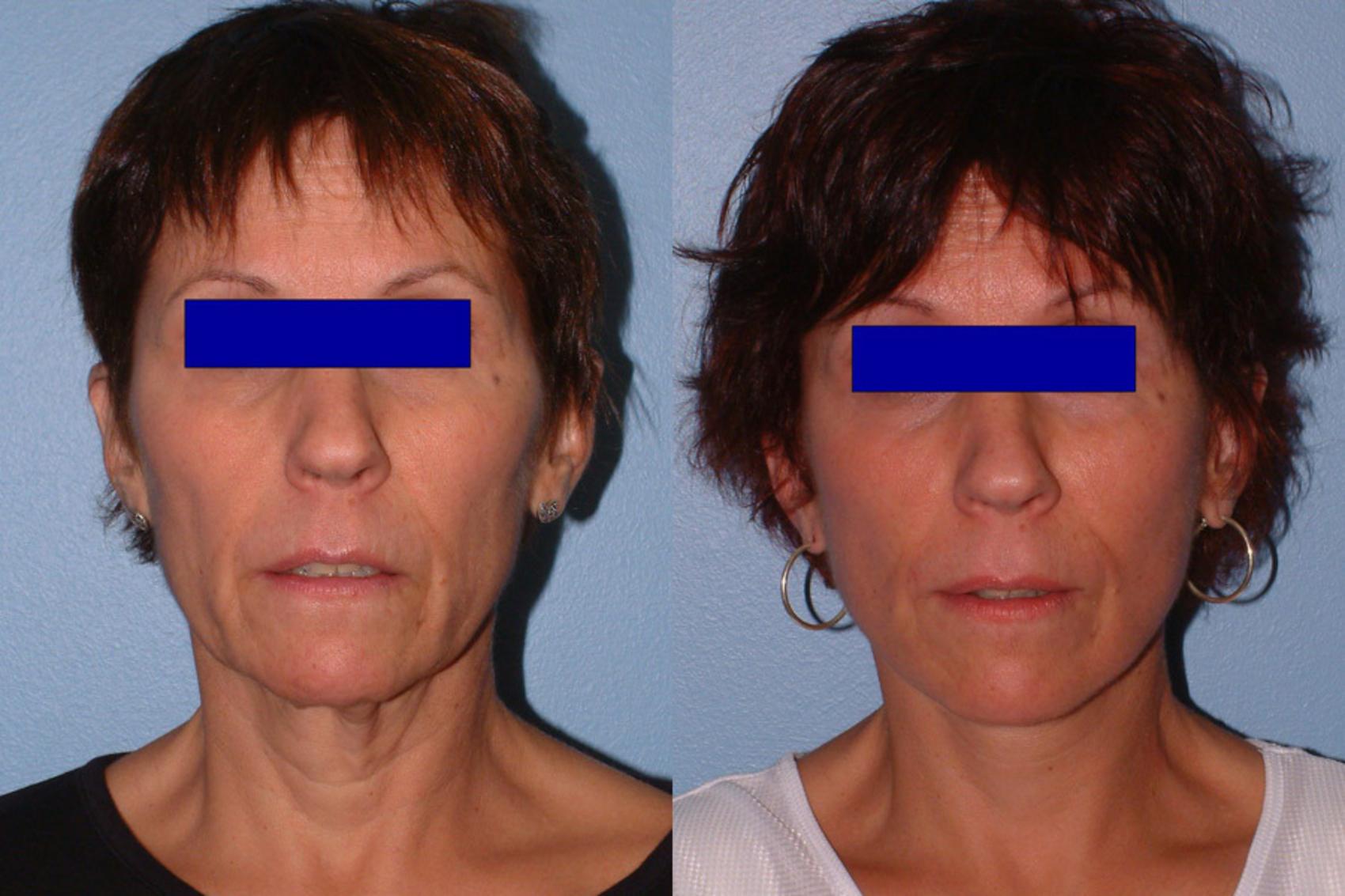 Facelift Case 7 Before & After View #1 | Downers Grove, IL | Dr. Sandeep Jejurikar