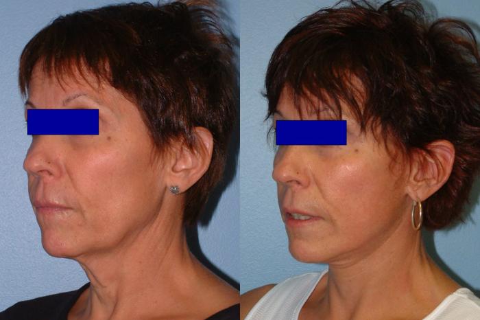 Facelift Case 7 Before & After View #2 | Downers Grove, IL | Dr. Sandeep Jejurikar