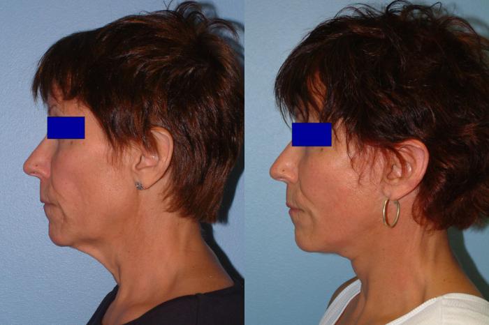 Facelift Case 7 Before & After View #3 | Downers Grove, IL | Dr. Sandeep Jejurikar