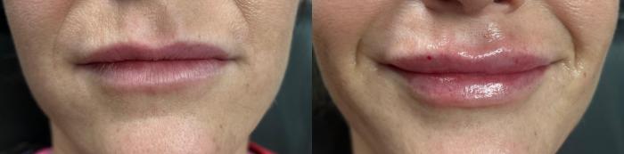 Facial Filler Case 104 Before & After Front | Downers Grove, IL | Dr. Sandeep Jejurikar