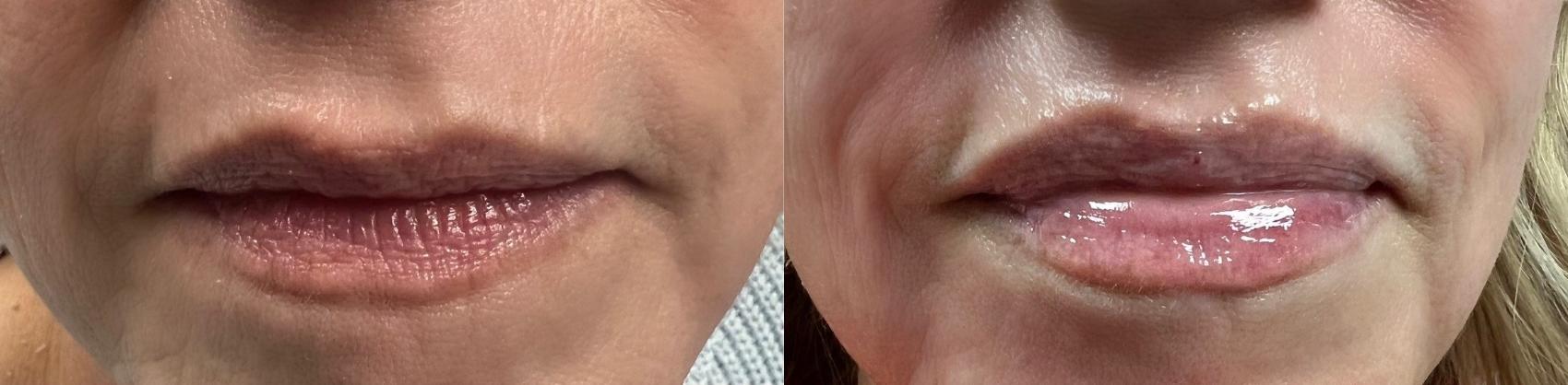 Facial Filler Case 79 Before & After Front | Downers Grove, IL | Dr. Sandeep Jejurikar