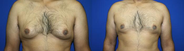 Gynecomastia Case 128 Before & After Front | Downers Grove, IL | Dr. Sandeep Jejurikar