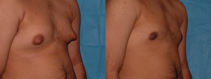 Gynecomastia Case 24 Before & After View #2 | Downers Grove, IL | Dr. Sandeep Jejurikar